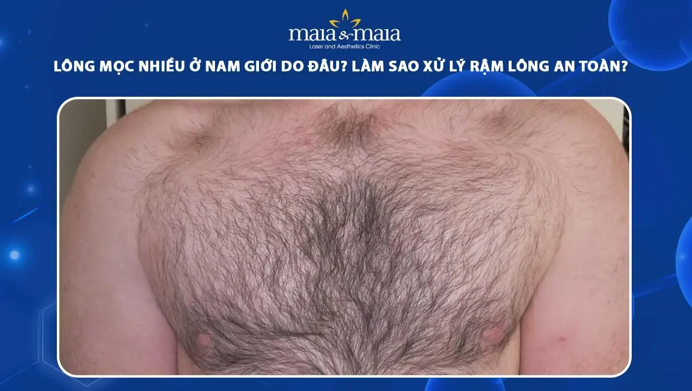 Lông mọc nhiều ở nam giới do đâu? Cách xử lý hiệu quả