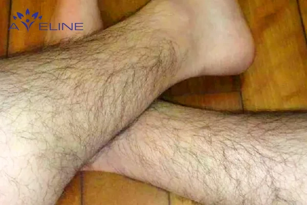 Lý giải tại sao lông chân mọc nhiều ở nam?